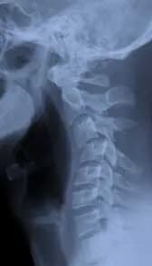 Radiografía de Columna Lumbar en Villahermosa BIMO